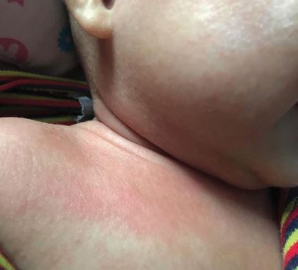“Con mình mới 4 tháng tuổi mà bị mẩn đỏ hết cả người”, chị Phan Hà cho biết
